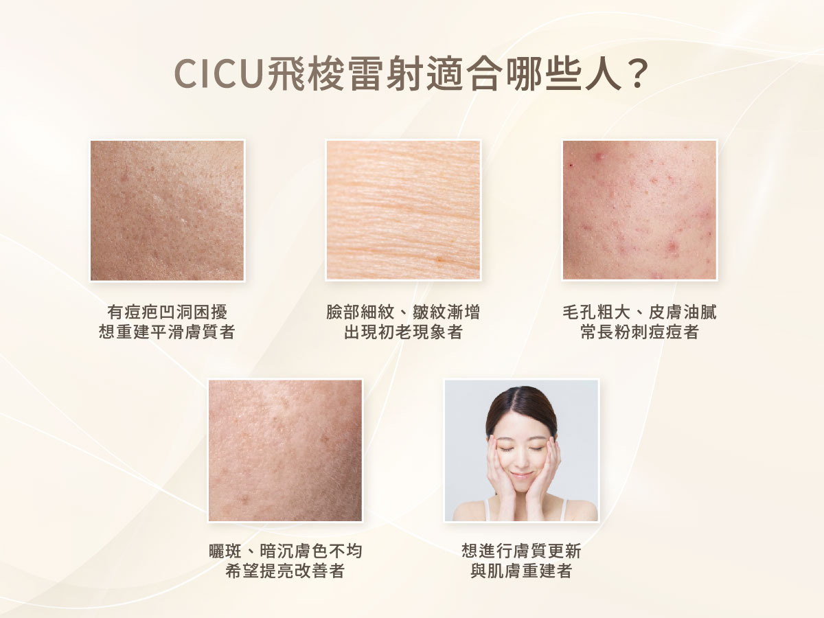 CICU飛梭雷射-適合哪些人